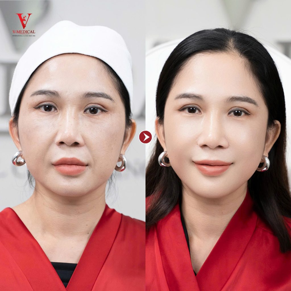 Trẻ hóa da công nghệ Ultherapy Prime trước sau thực hiện