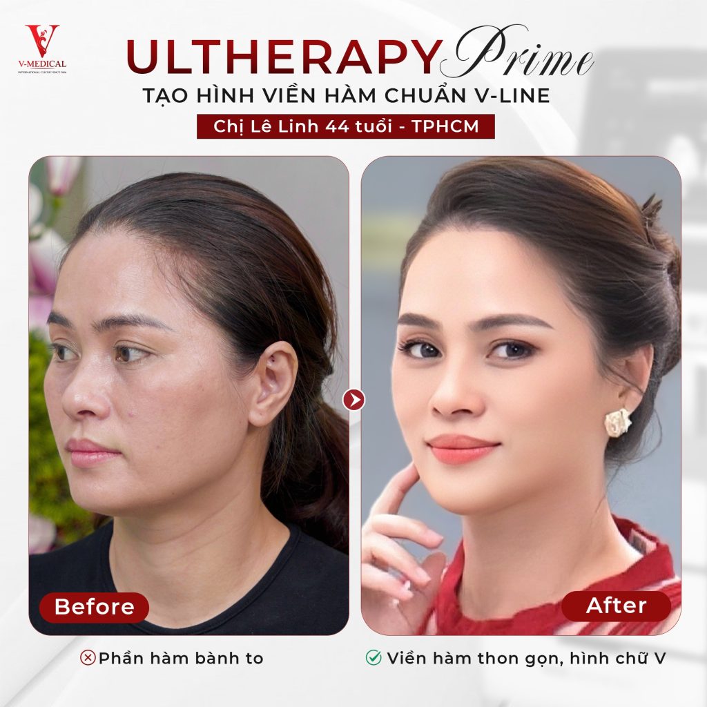 Nâng cơ mặt Utherapy Prime