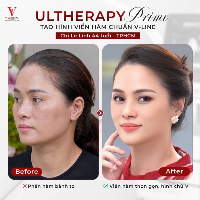 Nâng cơ mặt Utherapy Prime