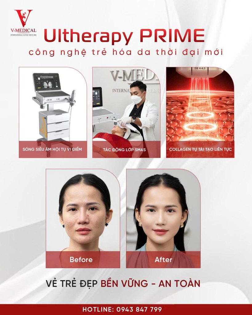 Trẻ hóa da ultherapy prime