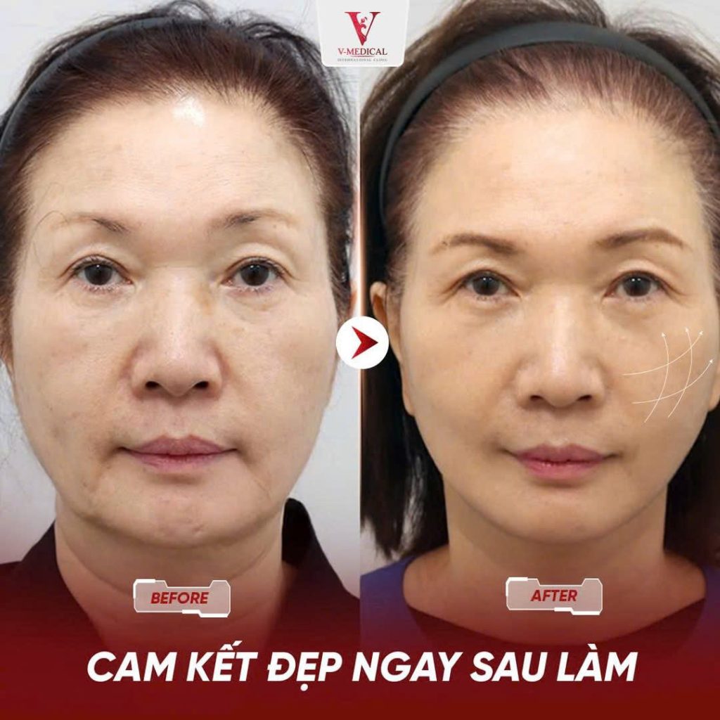 xóa nhăn công nghệ cao
