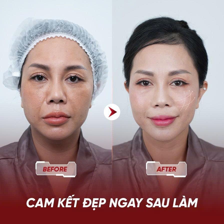 Hình ảnh trước sau trẻ hóa da công nghệ cao của Vmedical